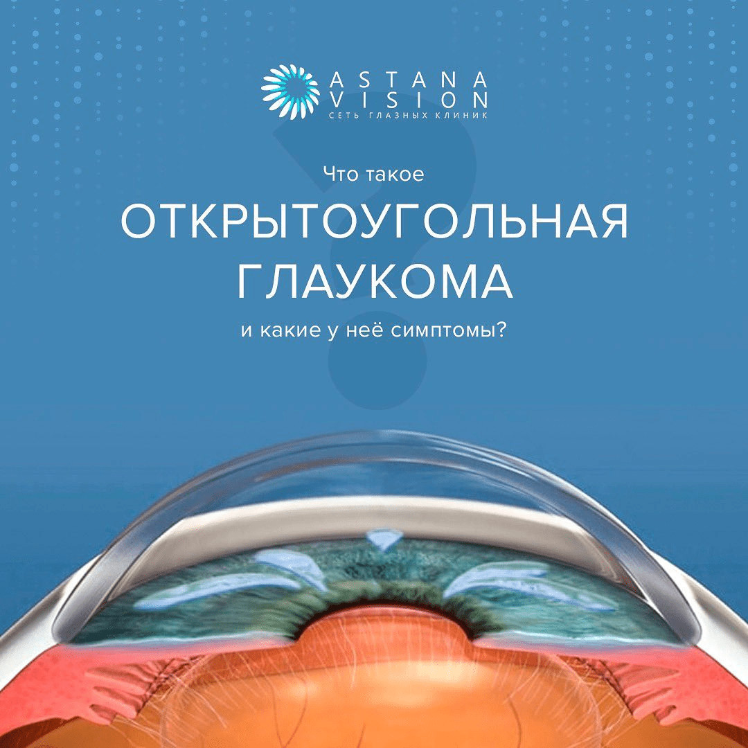 Что такое открытоугольная глаукома и как ее распознать? - Astana Vision